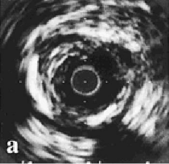 Fig 1: Coronary calcification.